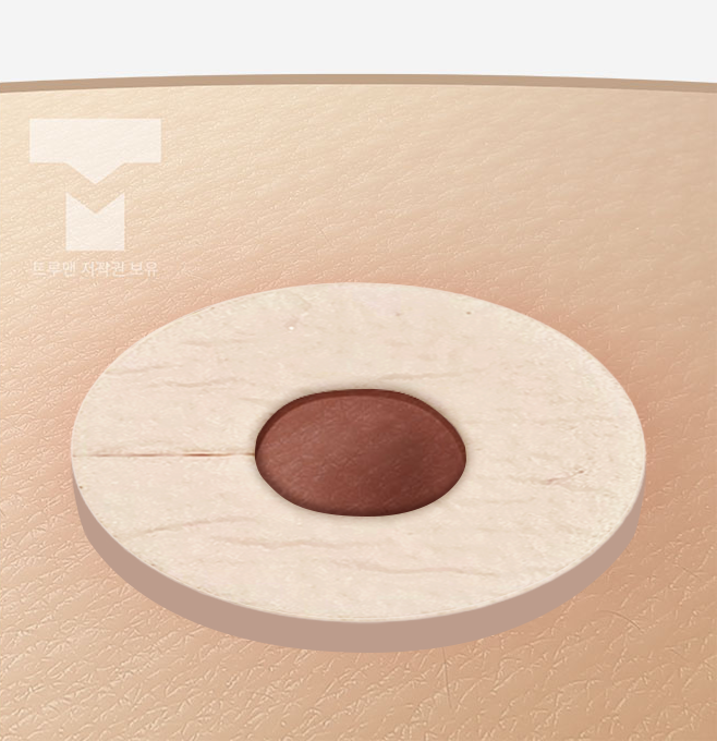 유두 보호 드레싱