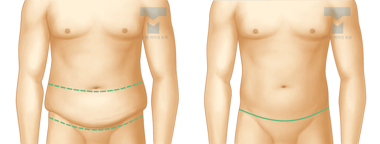 처진 복부 교정 수술