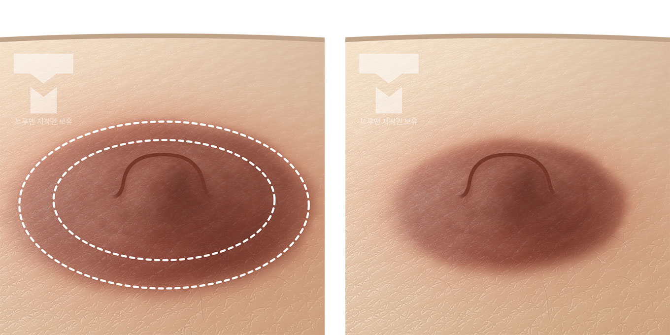 Areola Reduction Surgery Method