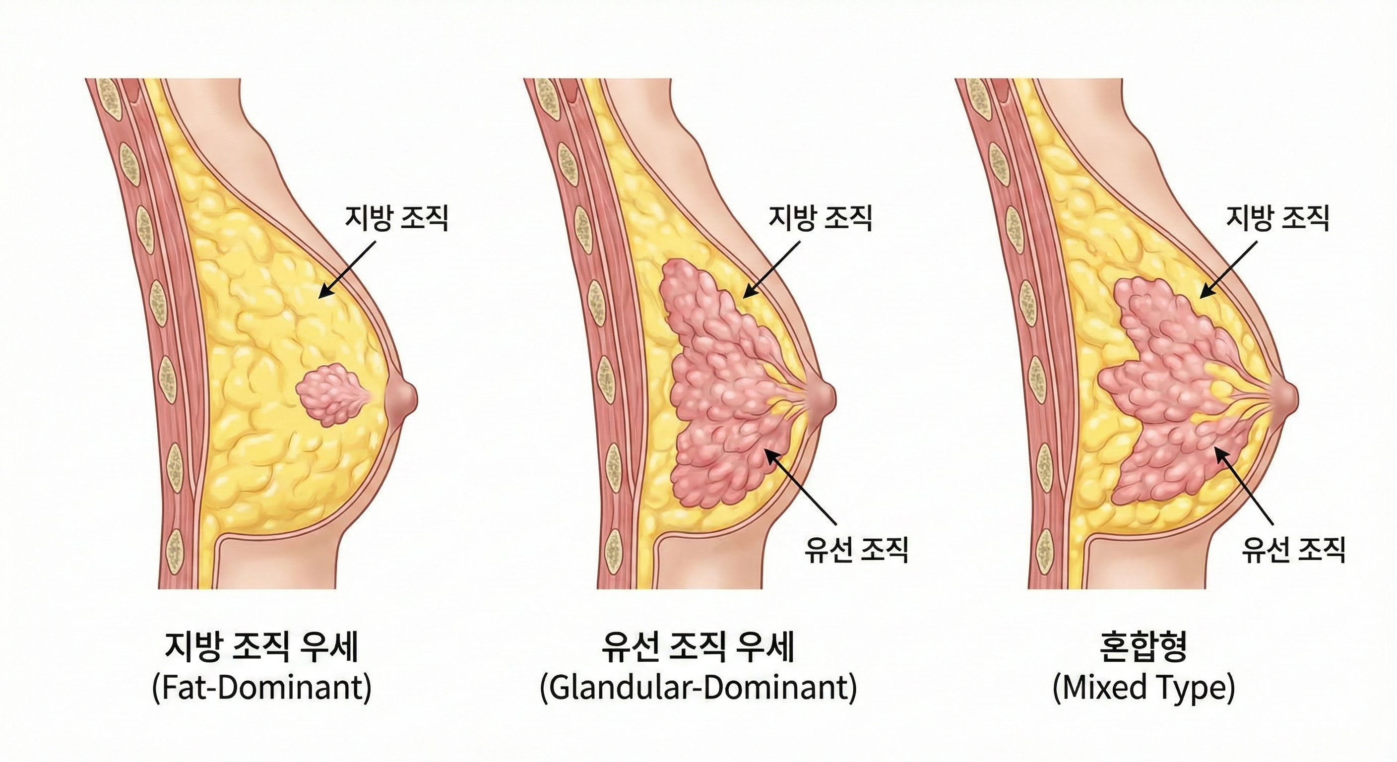 Gynecomastia Types Diagram