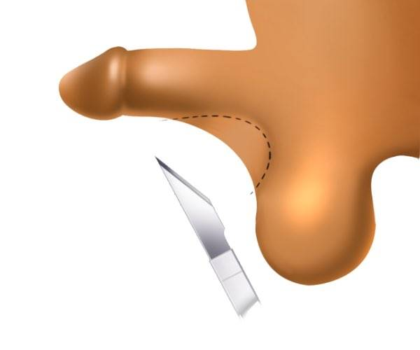 Procedure illustration 2