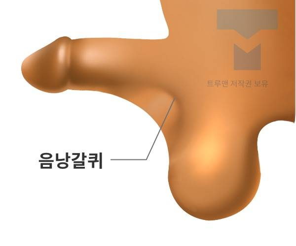 Procedure illustration 1