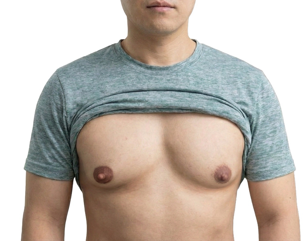 여유증과 유두가 비대한 경우