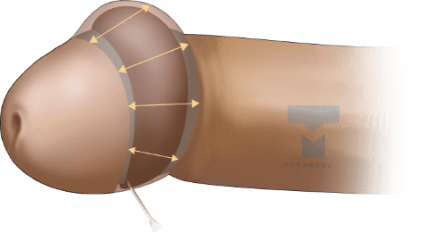 대체 진피 DNA 귀두 확대