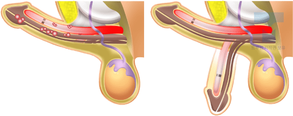 트루맨 발기부전 보형물 재수술 이미지