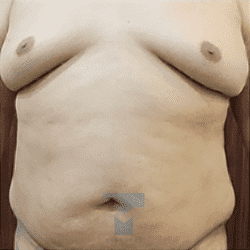 고주파 치료 전