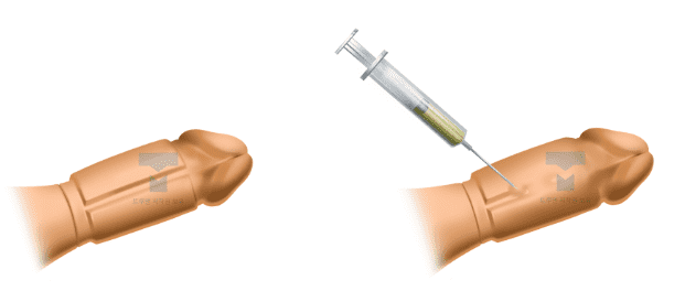 로우-블록 음경확대