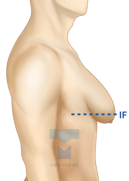 사이먼 등급 III