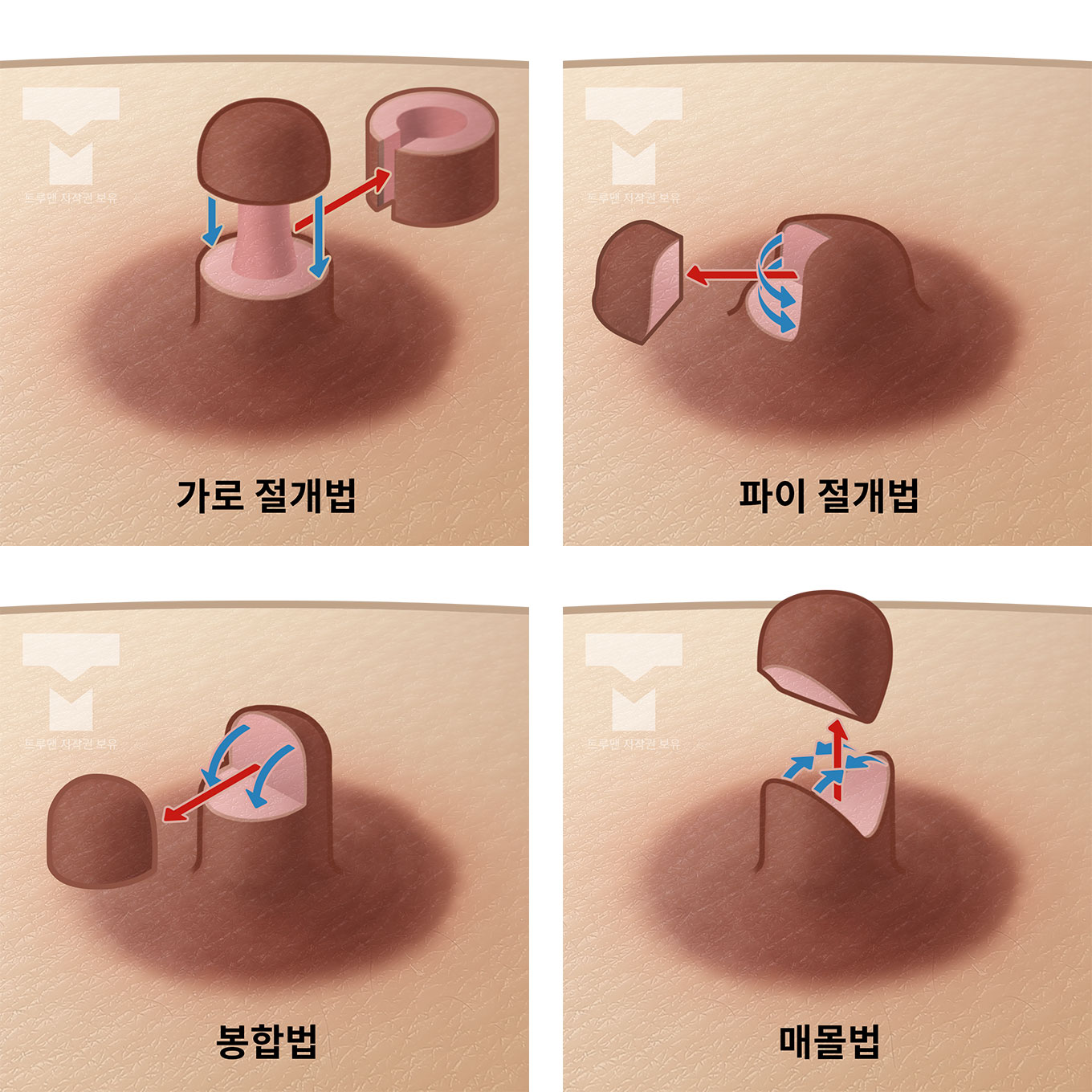 Surgery Method Illustration 1