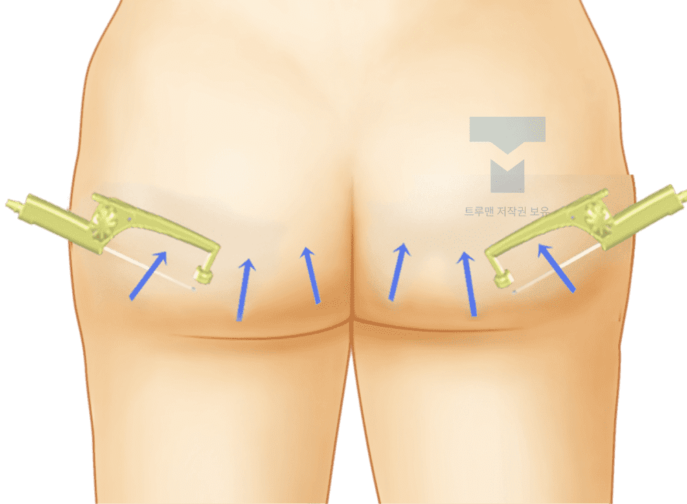Buttocks Liposuction Diagram