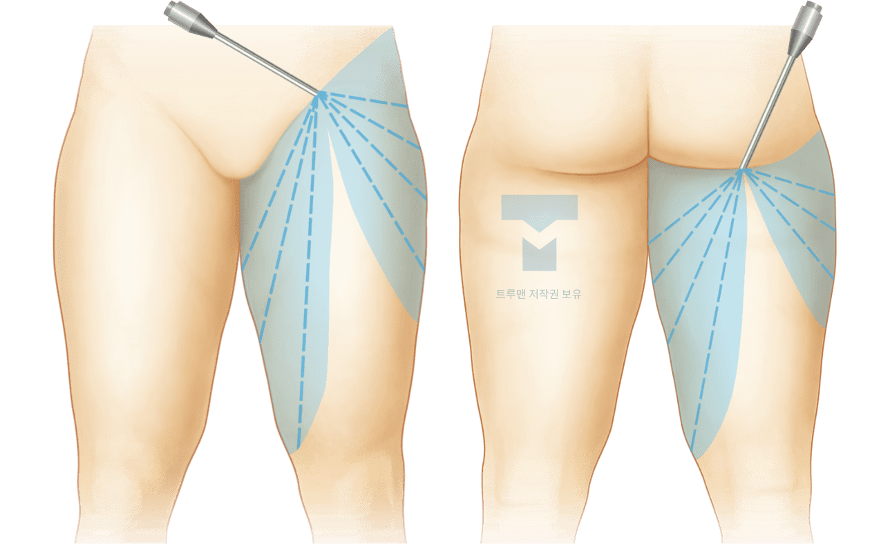 Thigh Liposuction Diagram