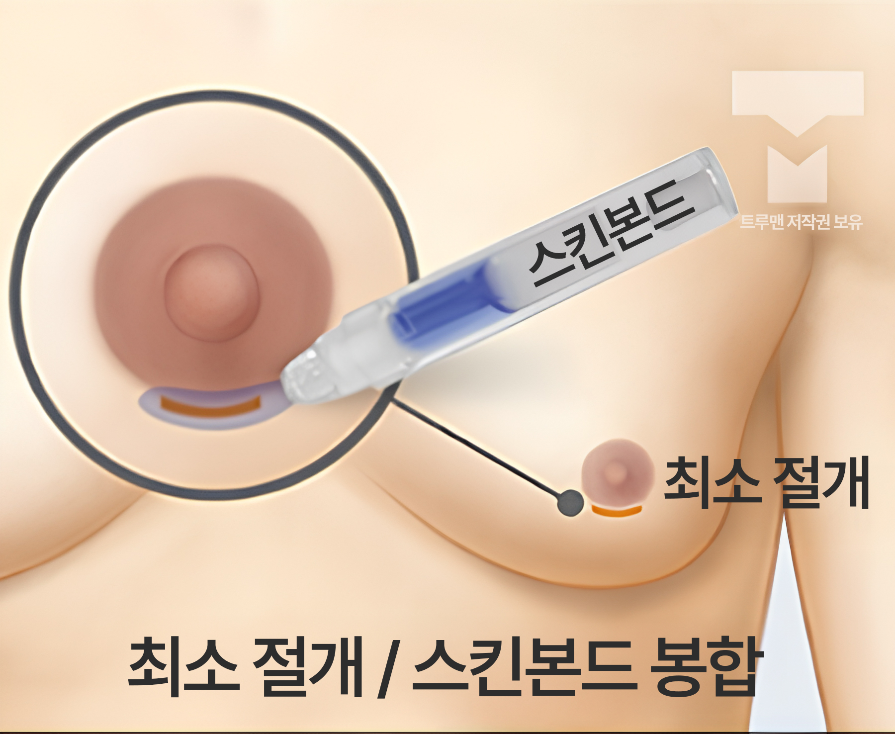 스킨본드 최소 절개 봉합