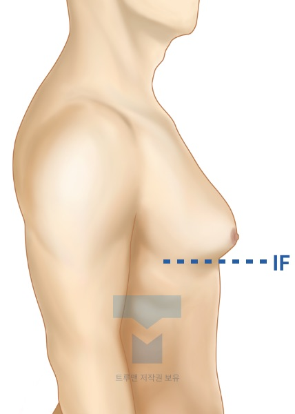 사이먼 등급 IIa