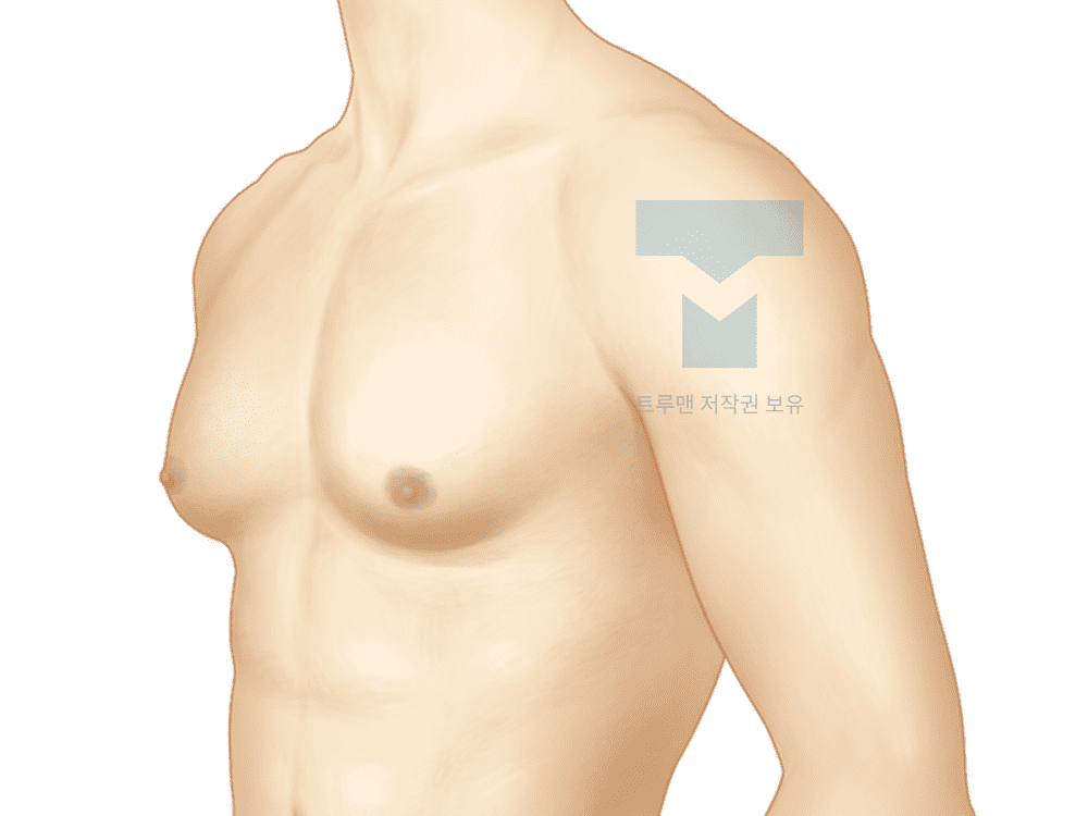 여유증 재발 또는 낮은 치료 효과