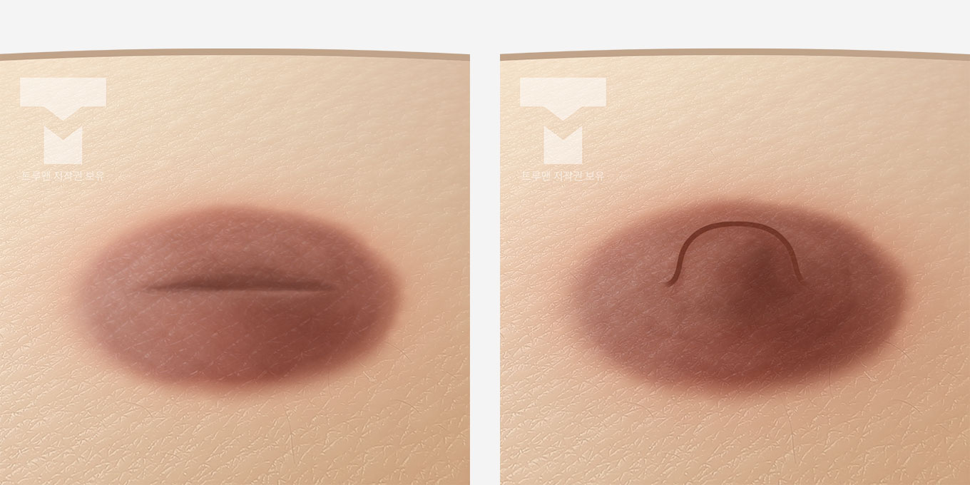 Inverted Nipple Surgery Method