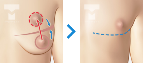 처진 가슴 교정 수술