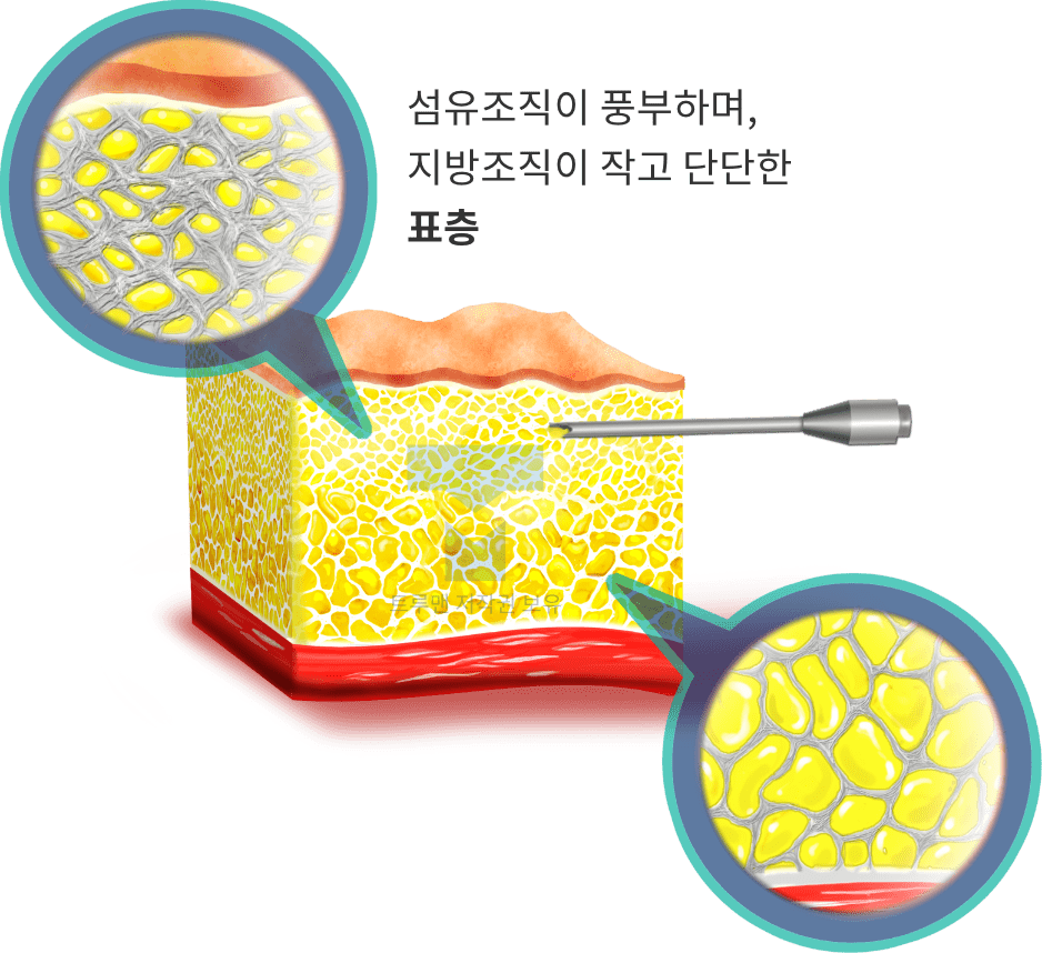 자가조직 DNA 귀두 확대