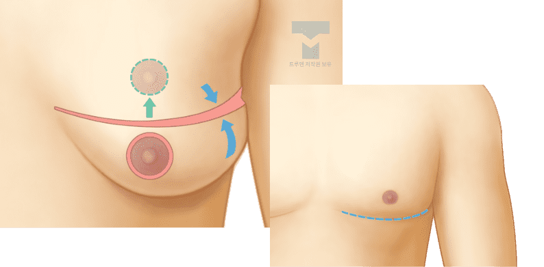 처진 가슴 교정 수술 설명 이미지
