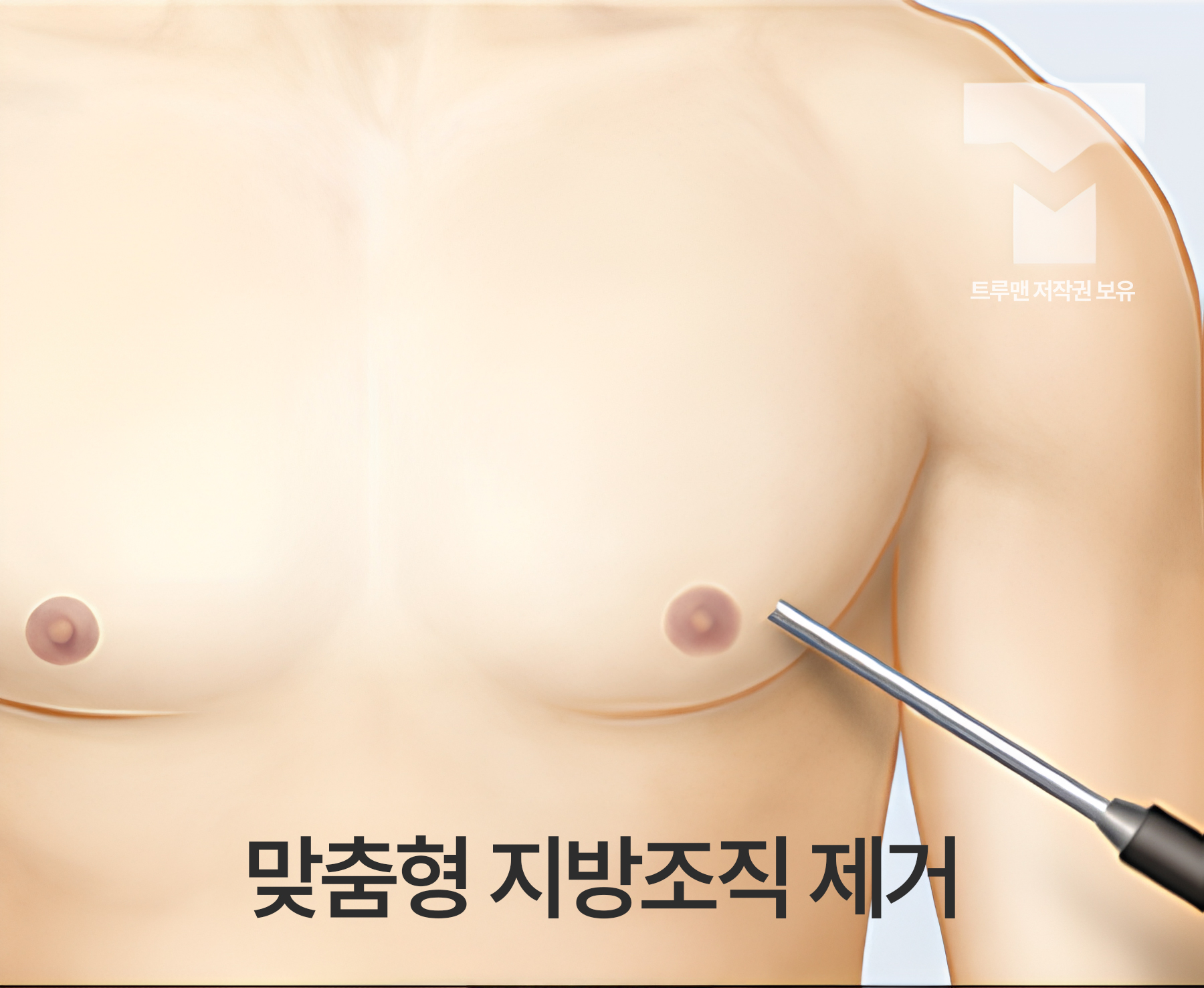 맞춤형 지방조직 제거