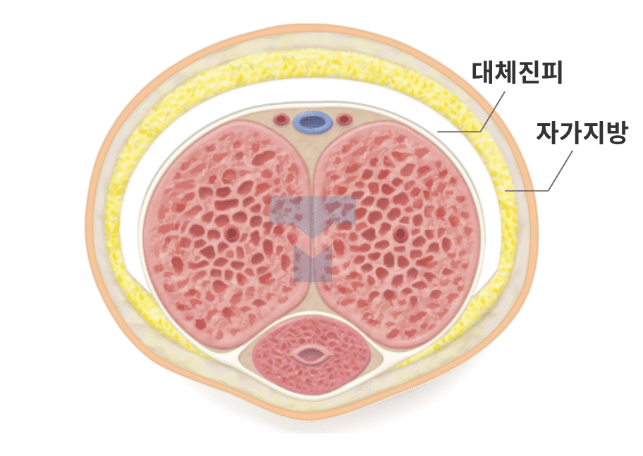 단순 대체진피 확대