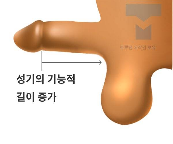 Procedure illustration 3