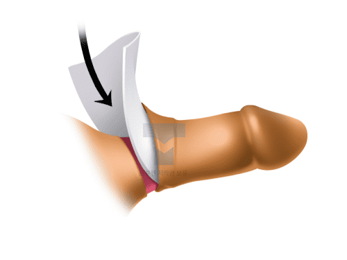 대체진피 DNA 확대 수술 이미지