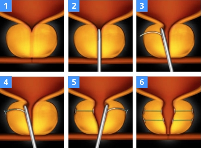 Urolift Procedure Diagram