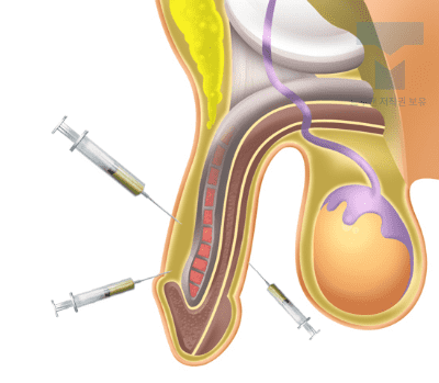 자가조직 DNA 확대 수술 이미지